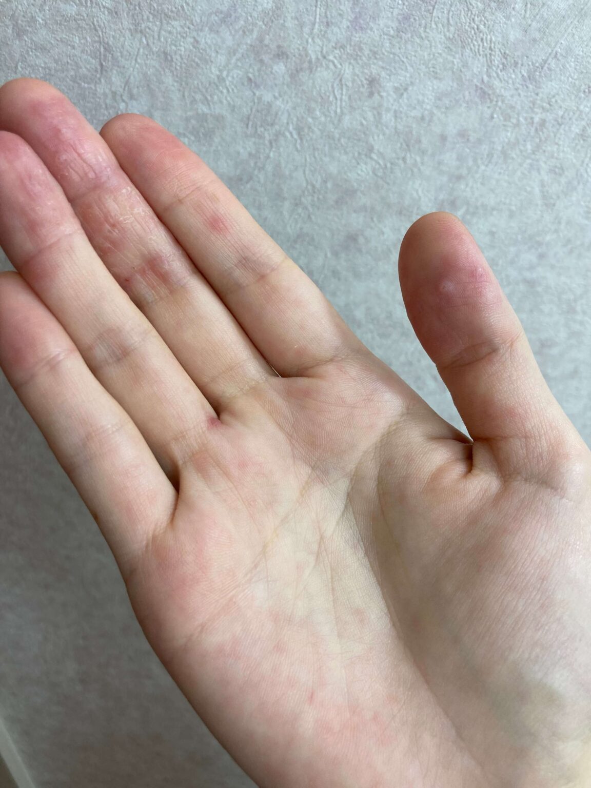 【体験談】大人の手足口病の症 …